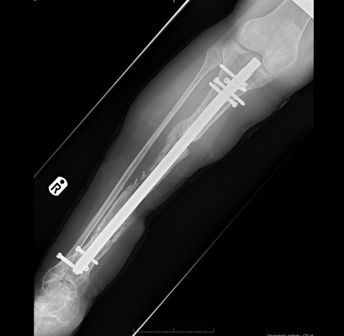 Xrays after insertion of intramedullary nail
