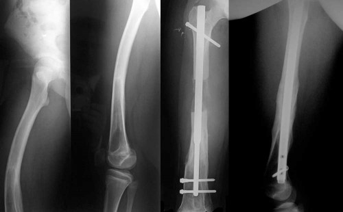 Bow femur, fixed with an intramedullary nail.
