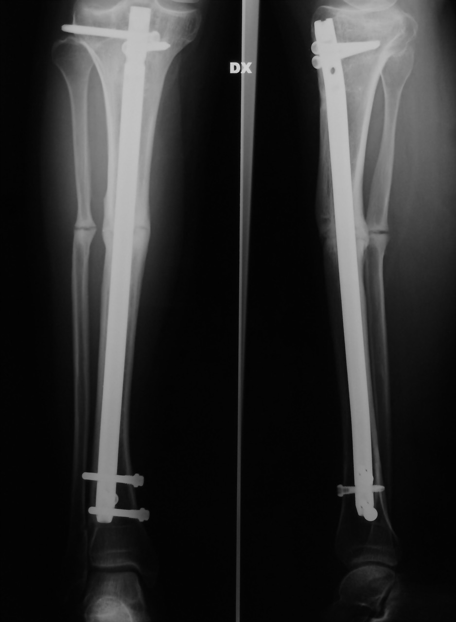tibia2