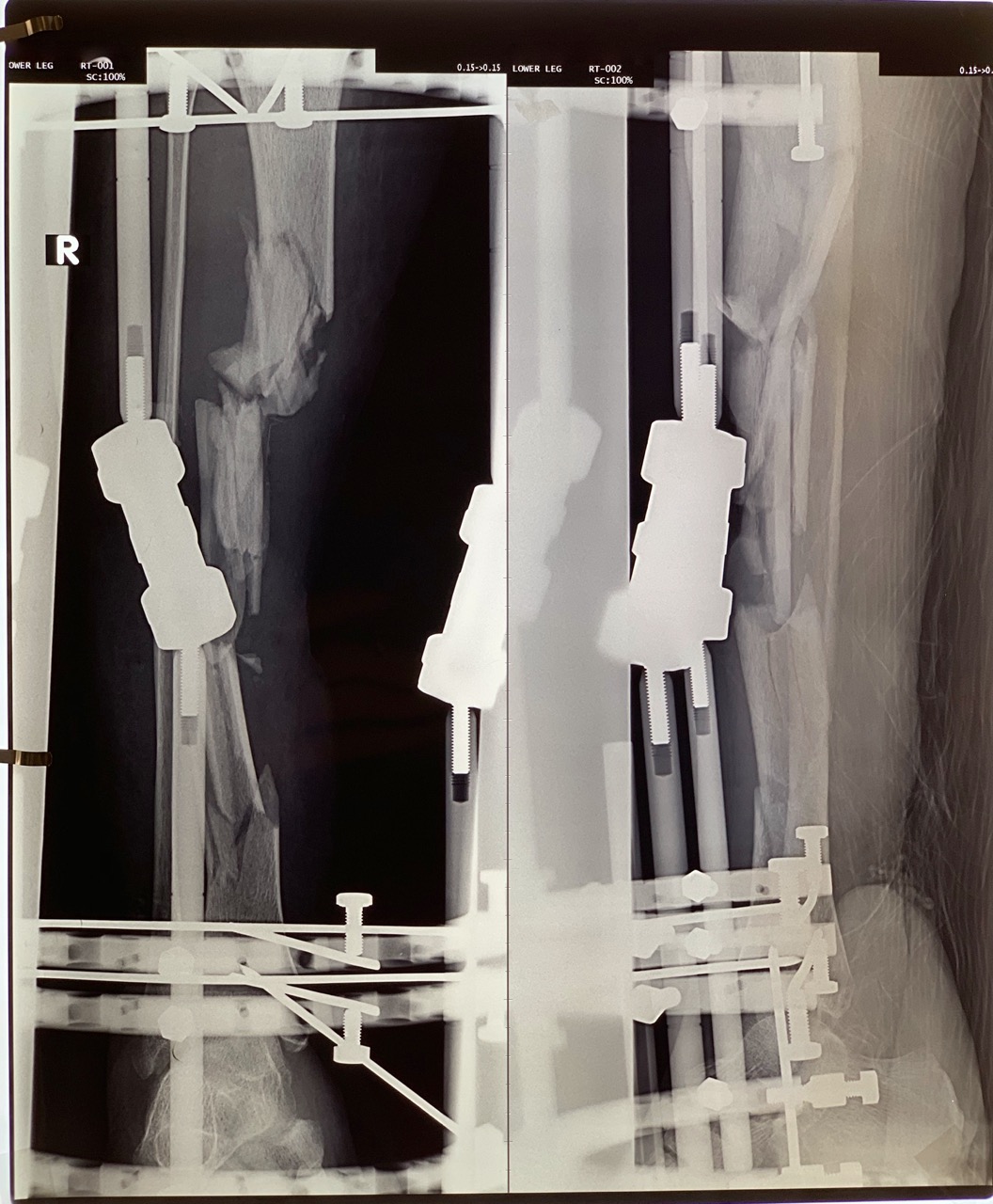 Xrays with external fixator Xrays with external fixator